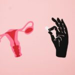Women with polycystic ovary syndrome exhibit impaired endometrial receptivity with excessive ER and histone lactylation