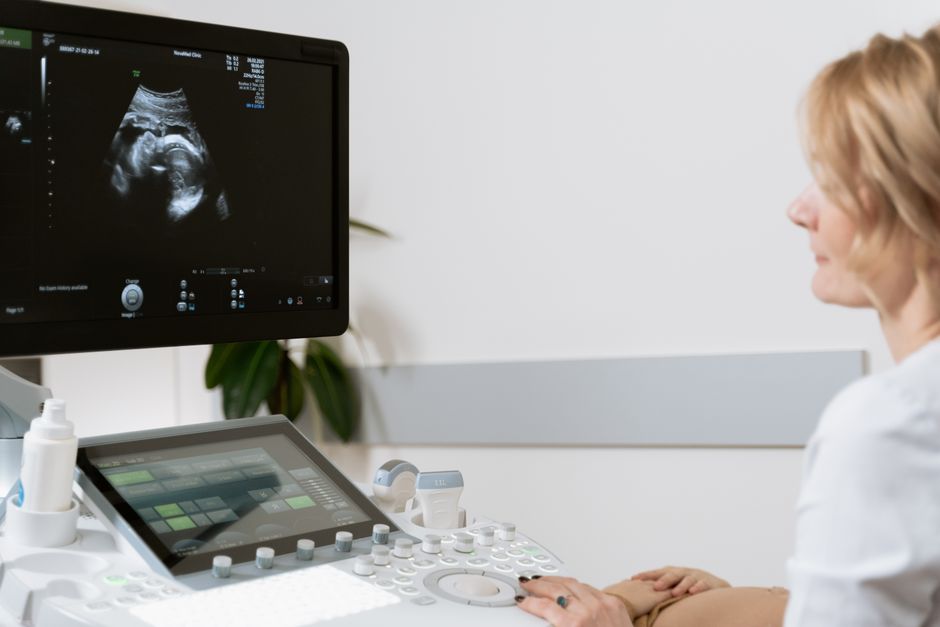 Women with polycystic ovary syndrome exhibit impaired endometrial receptivity with excessive ER and histone lactylation
