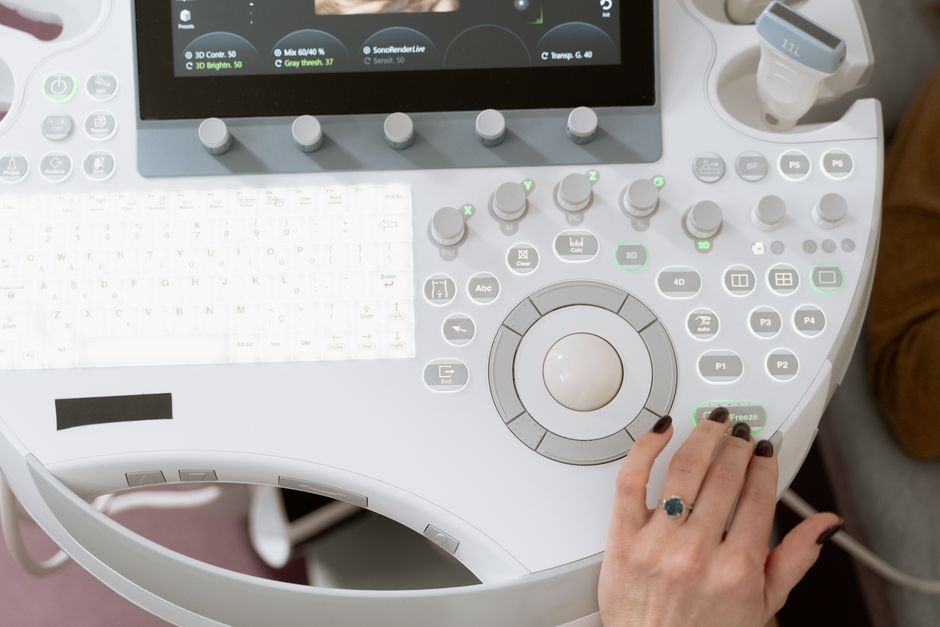 Women with polycystic ovary syndrome exhibit impaired endometrial receptivity with excessive ER and histone lactylation