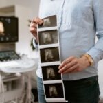 Women with polycystic ovary syndrome exhibit impaired endometrial receptivity with excessive ER and histone lactylation