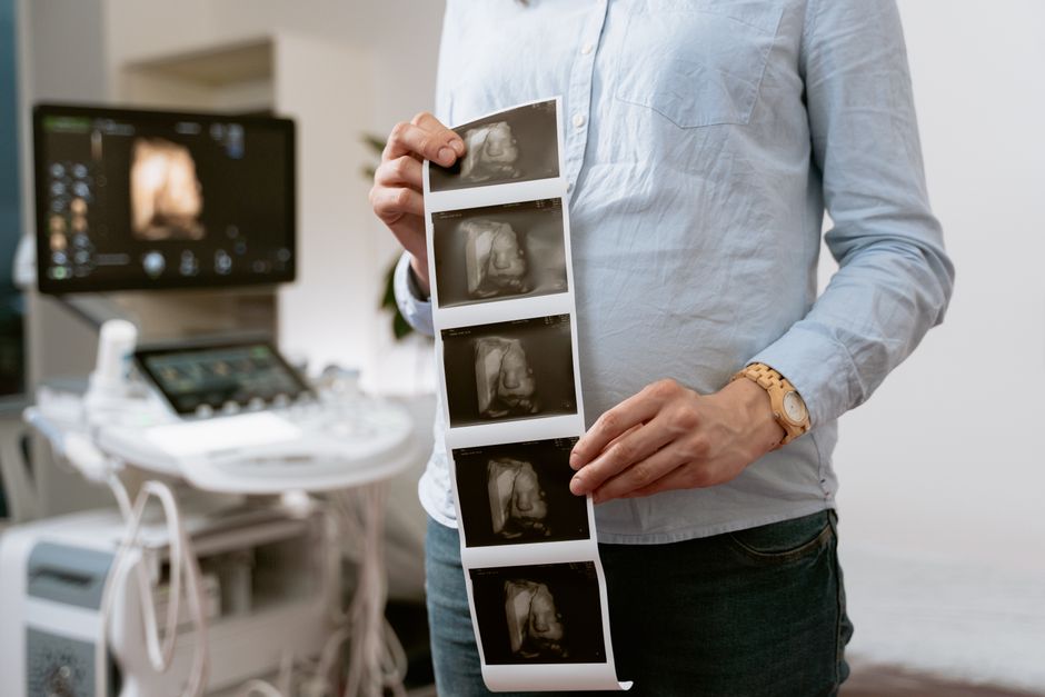 Women with polycystic ovary syndrome exhibit impaired endometrial receptivity with excessive ER and histone lactylation