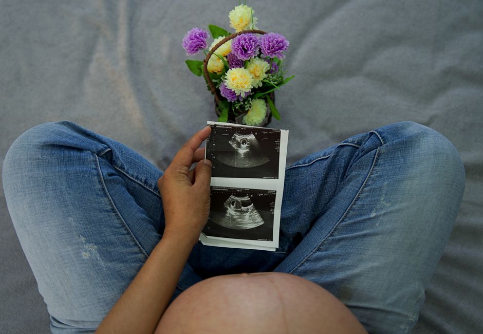 Women with polycystic ovary syndrome exhibit impaired endometrial receptivity with excessive ER and histone lactylation